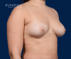 Fat Transfer to Breasts, 500cc per breast, by Dr. John Burns 500cc per breast, by Dr. John Burns