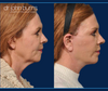 Profile View, Before & After Facelift and neck lift by Dallas Facelift specialist Dr. John Burns, FACS