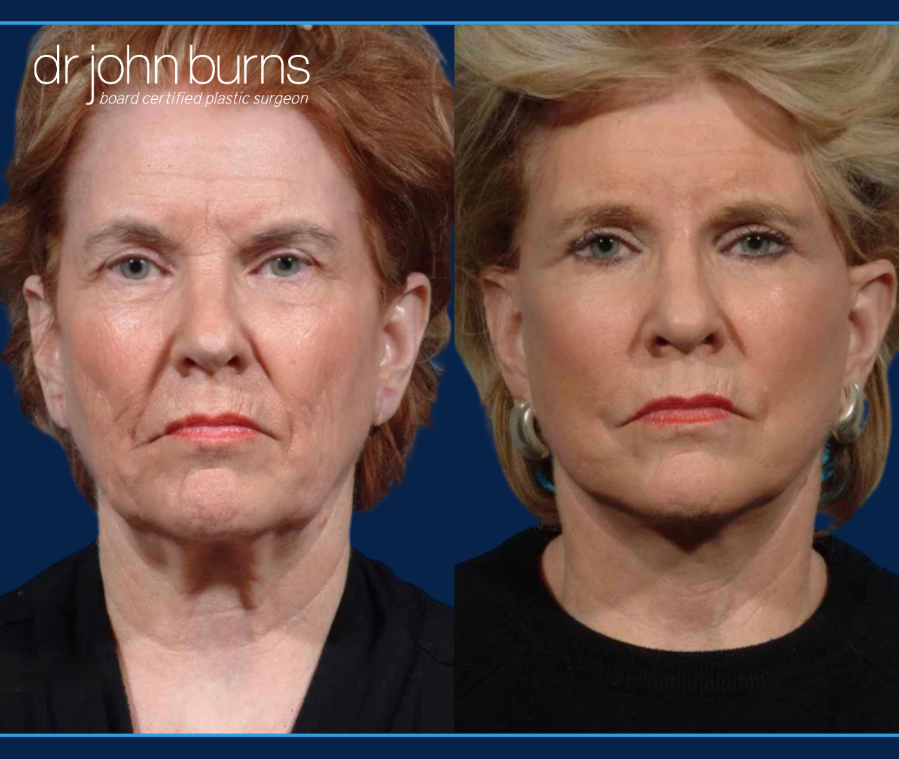 Before & After Facelift and neck lift with fat graftingby Facelift specialist Dr. John Burns, FACS