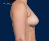 Profile View, Fat Transfer to Breasts, 500cc per breast, by Dr. John Burns