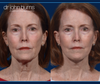 Before & After Facelift and neck lift by Facelift specialist Dr. John Burns, FACS