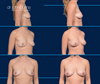 Before and After 425cc Fat Transfer to each breast by Dr. Burns