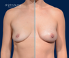 Before and After 425cc Fat Transfer to each breast by Dr. Burns