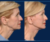 Profile View, Before & After Facelift and neck lift by Facelift specialist Dr. John Burns, FACS
