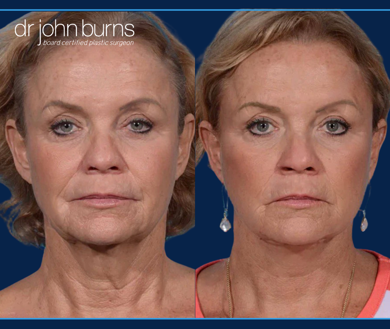 Before & After Facelift and neck lift by Facelift specialist Dr. John Burns, FACS