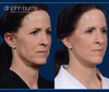 Before and After facelift surgery by Facelift specialist Dr. John Burns in Dallas