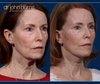 Before & After Facelift and neck lift by Facelift specialist Dr. John Burns, FACS