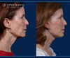 Profile View, Before & After Facelift and neck lift by Facelift specialist Dr. John Burns, FACS