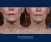 Mouth Area, Before & After Facelift and neck lift by Facelift specialist Dr. John Burns, FACS