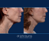 Profile View, Mouth Area, Before & After Facelift and neck lift by Facelift specialist Dr. John Burns, FACS