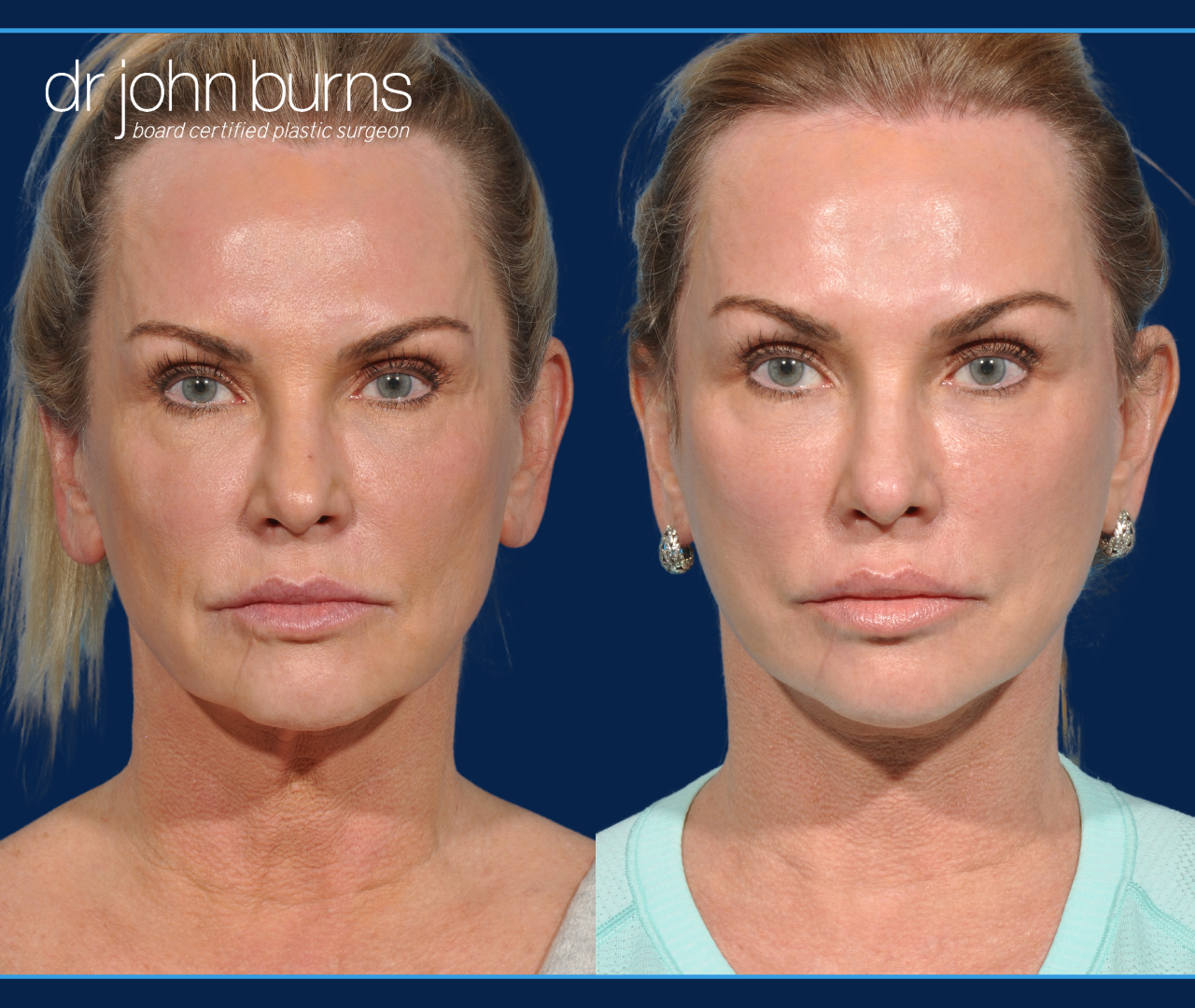 Facelift Revision | Dallas Facelift with  "Lift and Fill" Facelift with fat grafting to face by Dr. John Burns