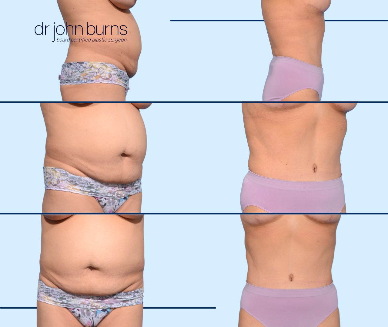 Before & After Corset Tummy Tuck by Dallas Plastic Surgeon, Dr. John Burns
