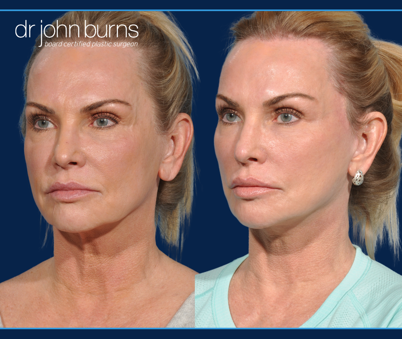 Facelift Revision | Dallas Facelift with 