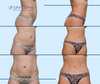 Before & After Tummy Tuck with Lipo 360 by Dallas Plastic Surgeon Dr. John Burns