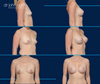 A to C Cup- Mommy Makeover Breast Augmentation- Dr. John Burns