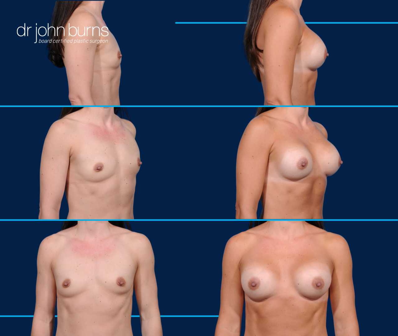 Athletic Breast Implant Results by Dr. John Burns