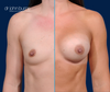 Before & After Athletic Breast Implants by Dr. John Burns