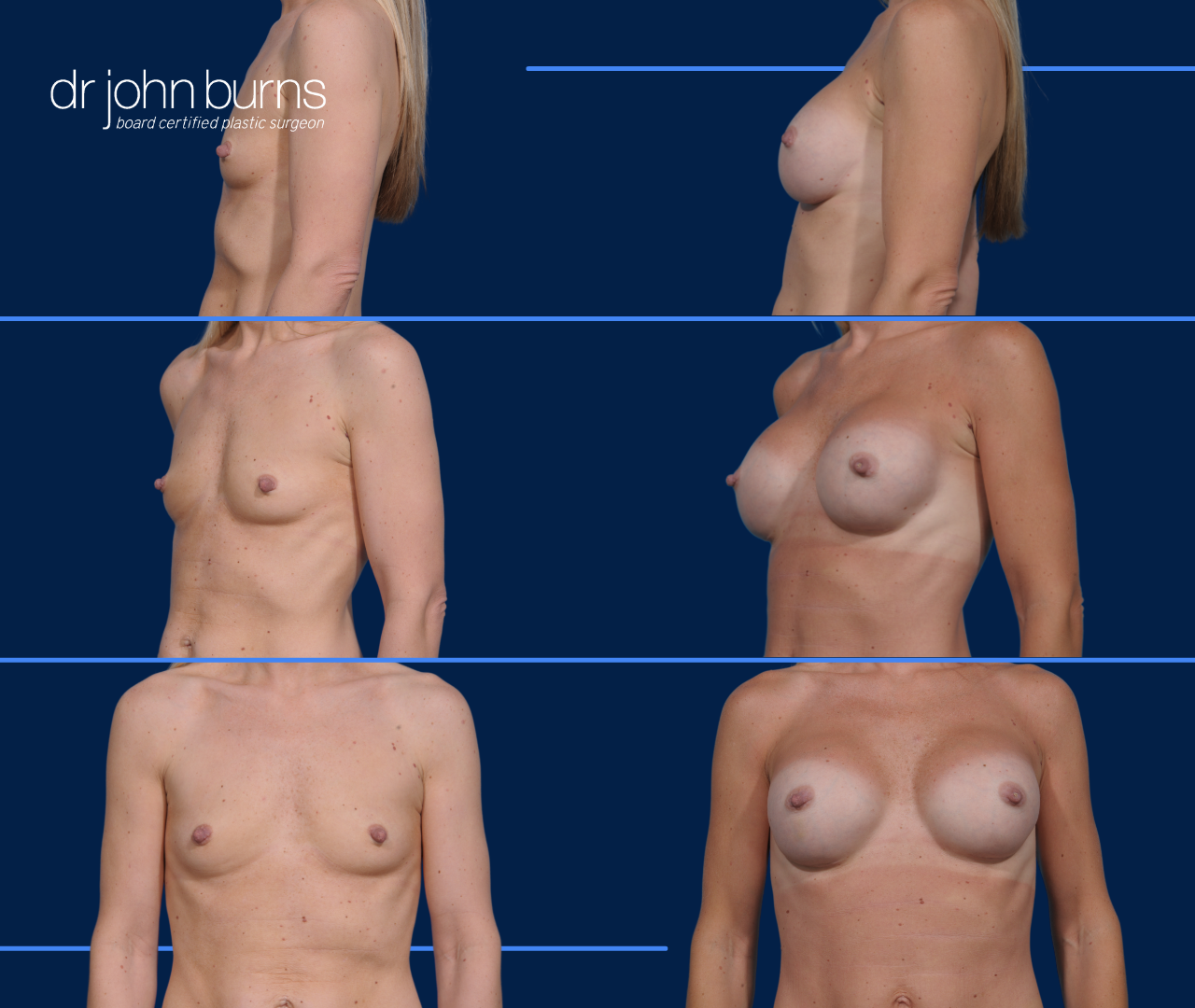 Breast Augmentation Results by Dr. John Burns