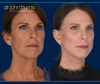 Before & After Facelift, Neck lift, fat transfer and laser resurfacing by Dr. John Burns in Dallas, Texas