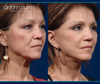 Before and After Facelift & Eyelid Surgery by Dallas Facelift Specialist Dr. John Burns, FACS