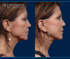 Profile View, Before and After Facelift & Eyelid Surgery by Dallas Facelift Specialist Dr. John Burns, FACS