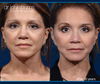 10 year facelift results showing before & 10 years after Facelift Surgery by Dr. John Burns