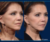 10 year facelift results showing before & 10 years after Facelift Surgery by Dr. John Burns