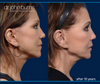 10 year facelift results showing before & 10 years after Facelift Surgery by Dr. John Burns