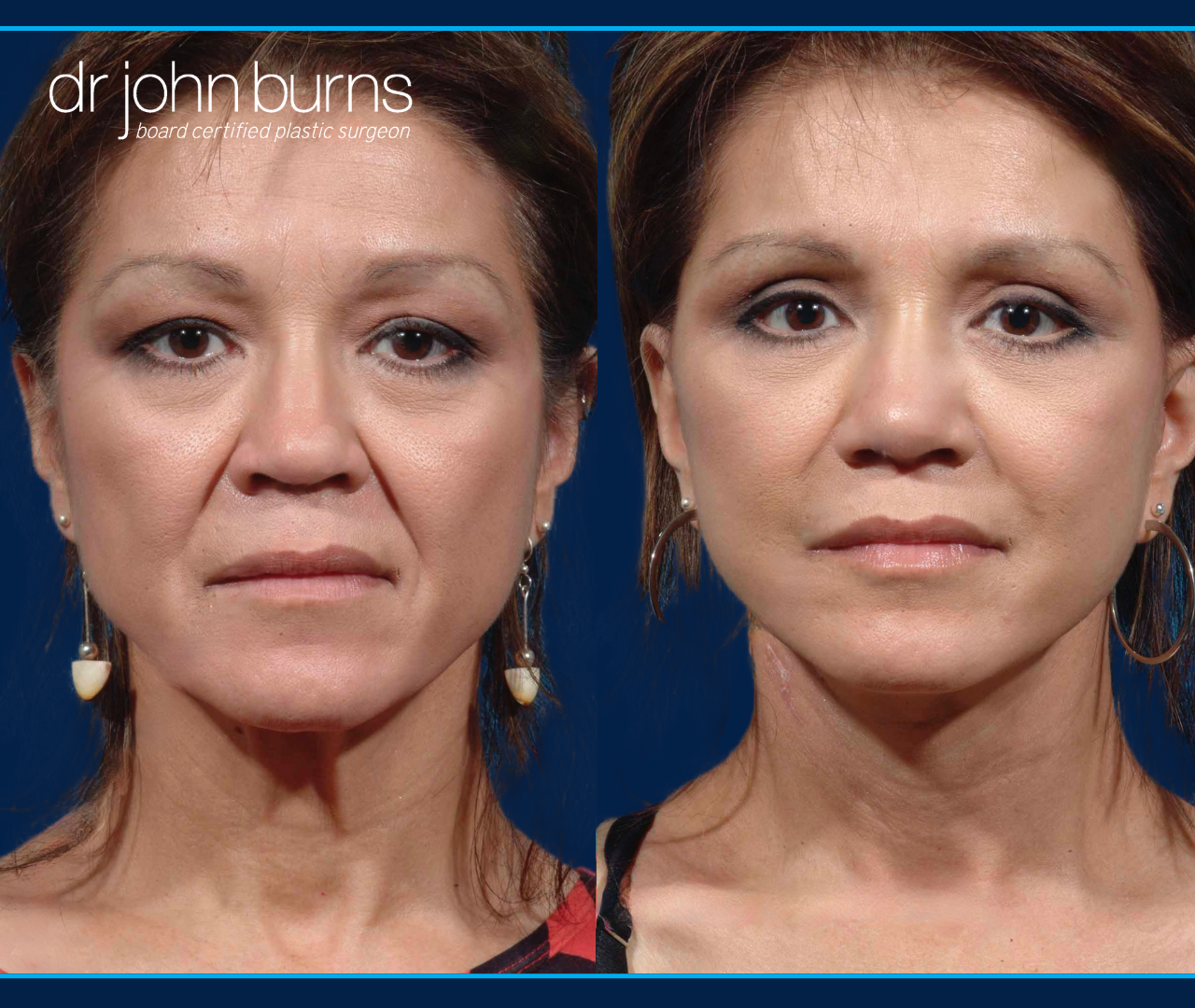 Before and After Facelift & Eyelid Surgery by Dallas Facelift Specialist Dr. John Burns, FACS