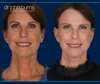 Before & After Facelift, Neck lift, fat transfer and laser resurfacing by Dr. John Burns in Dallas, Texas