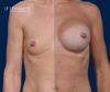 Before & After Silicone Gel Breast Implants