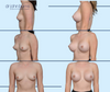 Before & After Silicone Gel Breast Implants by Dr. John Burns