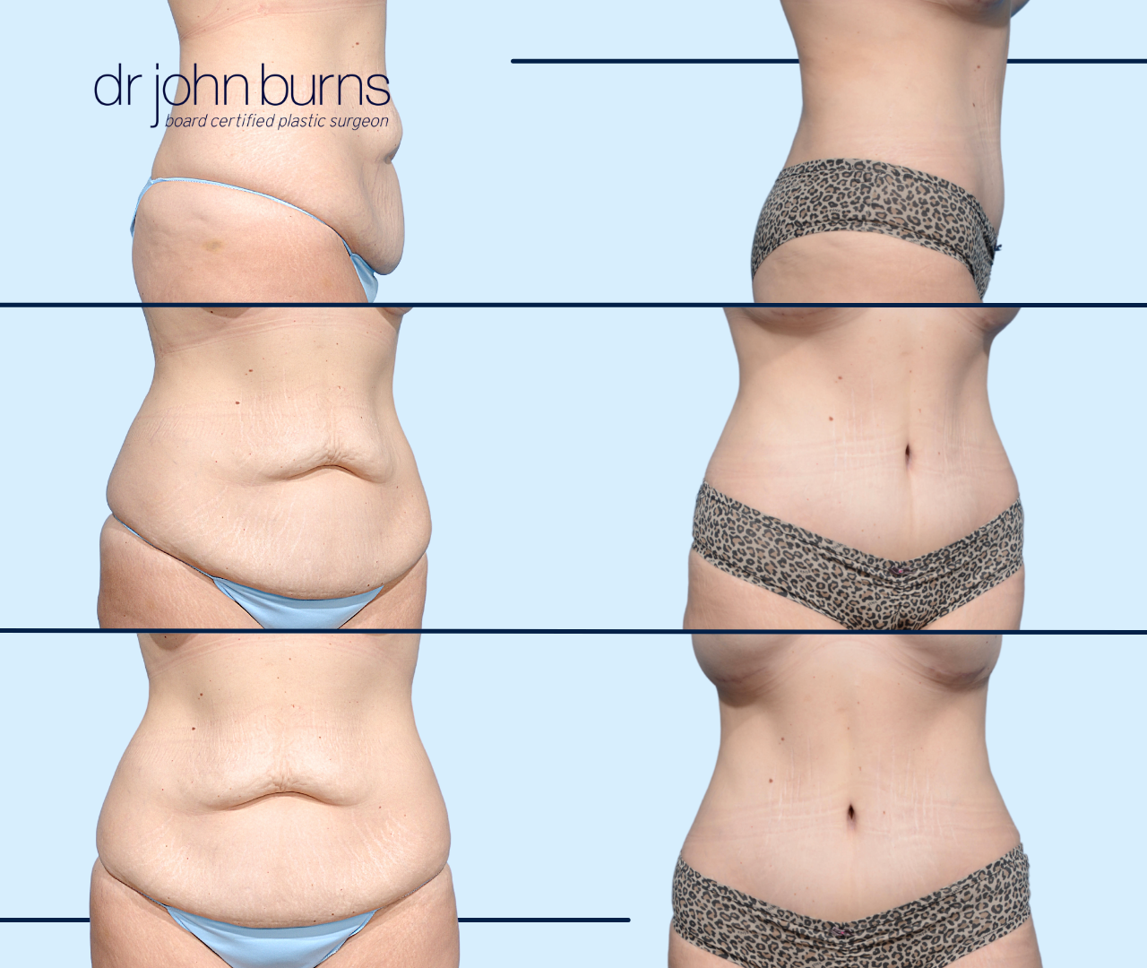 Before & After Extended Tummy Tuck Mommy Makeover by Dallas Plastic Surgeon Dr. John Burns
