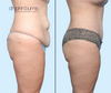 Profile View | Before & After Extended Tummy Tuck Mommy Makeover by Dallas Plastic Surgeon Dr. John Burns