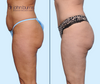 Profile View | Before & After Standard Tummy Tuck + Lipo 360 by Dallas Plastic Surgeon, Dr. John Burns