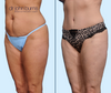45 Degree View | Before & After Standard Tummy Tuck + Lipo 360 by Dallas Plastic Surgeon, Dr. John Burns