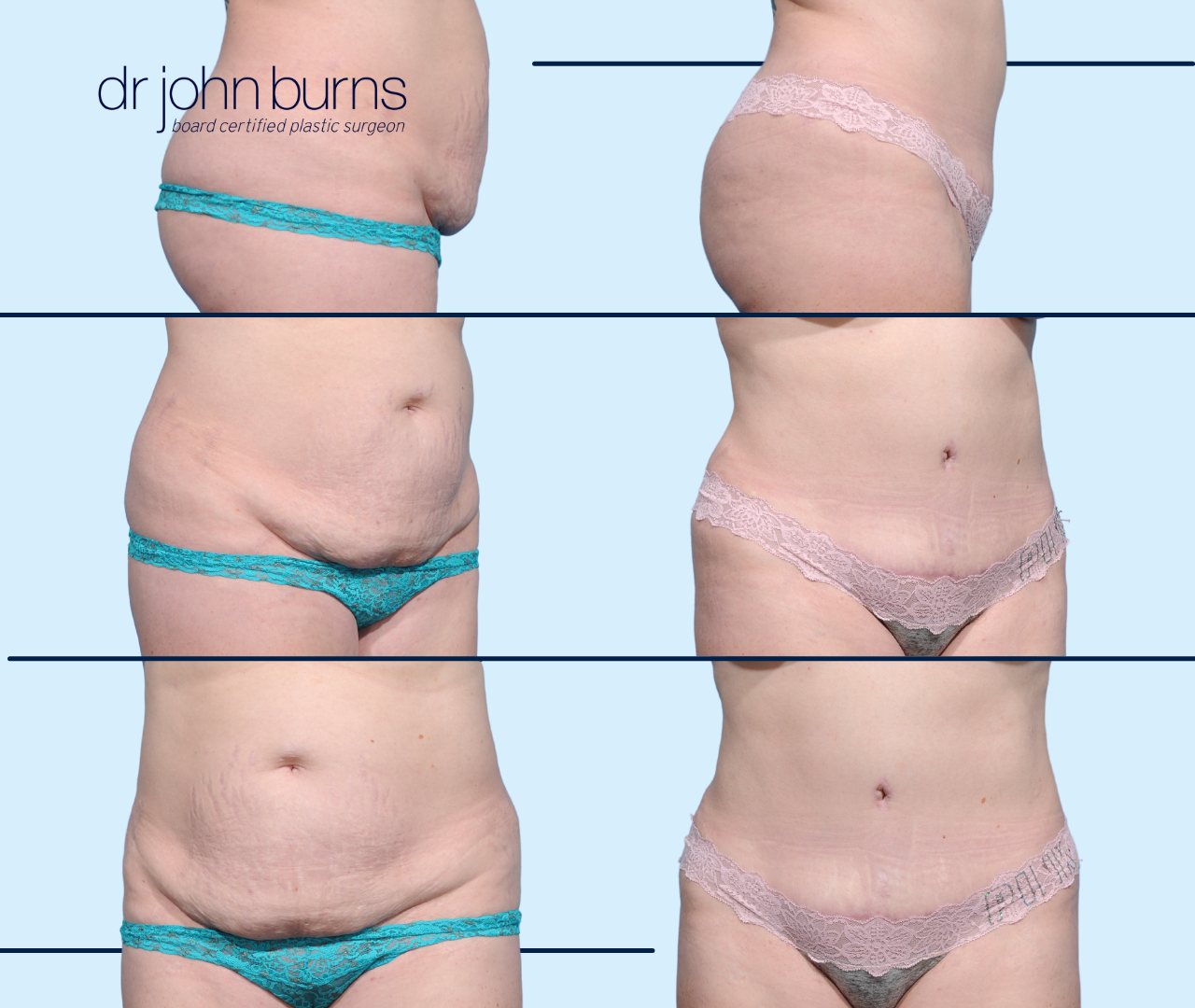 Before & After Corset Tummy Tuck as part of a mommy makeover by Dallas Plastic Surgeon, Dr. John Burns