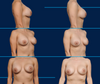 Before and After Breast Augmentation Revision by Dr. John Burns
