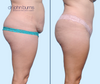 Profile View | Before & After Corset Tummy Tuck as part of a mommy makeover by Dallas Plastic Surgeon, Dr. John Burns