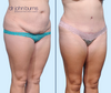 45 Degree View | Before & After Corset Tummy Tuck as part of a mommy makeover by Dallas Plastic Surgeon, Dr. John Burns