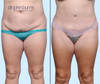 Anterior View | Before & After Corset Tummy Tuck as part of a mommy makeover by Dallas Plastic Surgeon, Dr. John Burns