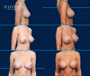 Before and After Breast Implants by Dr. John Burns in Dallas, Texas