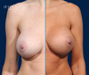 Split screen showing before and after breast augmentation by Dr. John Burns