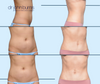 Mini Tummy Tuck Before & After | Dallas Plastic Surgery Institute | Dr. John Burns