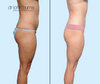 Profile View | Mini Tummy Tuck Before & After | Dallas Plastic Surgery Institute | Dr. John Burns