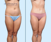 45 Degree View | Mini Tummy Tuck Before & After | Dallas Plastic Surgery Institute | Dr. John Burns