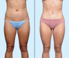 Anterior View | Mini Tummy Tuck Before & After | Dallas Plastic Surgery Institute | Dr. John Burns