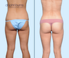 Posterior View | Mini Tummy Tuck Before & After | Dallas Plastic Surgery Institute | Dr. John Burns