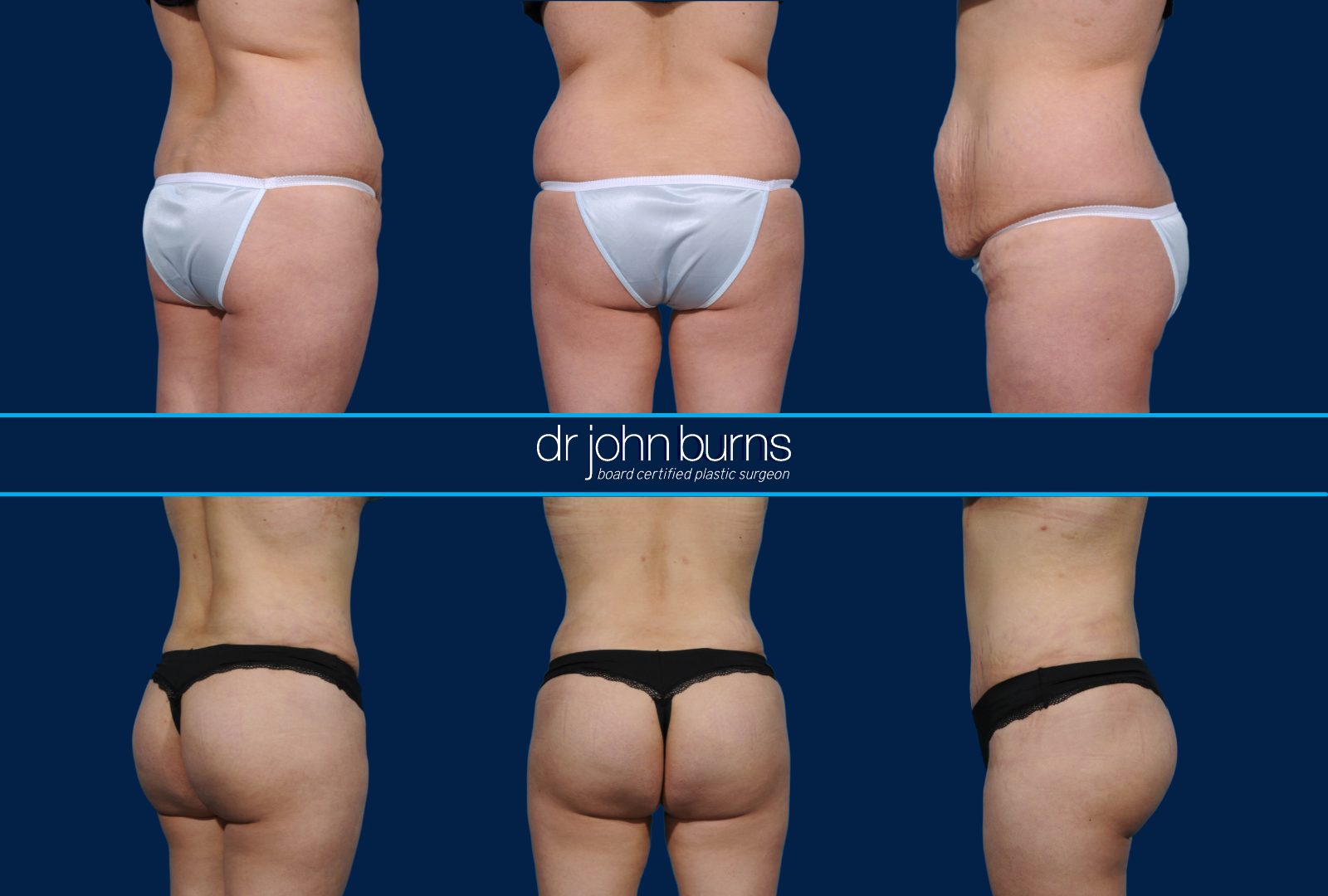 Dallas BBL-Brazilian Butt Lift- Before and After Pics by Dr. John