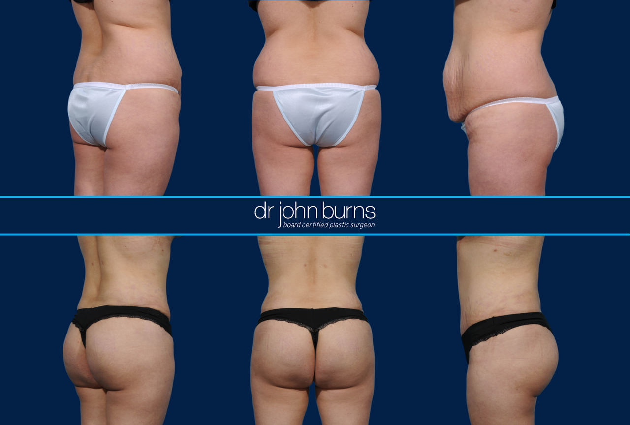 Before & After Brazilian Butt Lift (BBL)- BBL Surgeon - Dr. John Before & After Brazilian Butt Lift (BBL)- BBL Surgeon - Dr. John